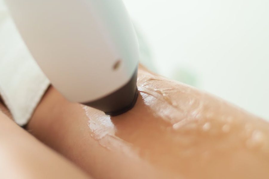 best laser for tattoo removal